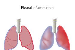 Плеврит легких: симптомы и лечение