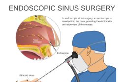 Эндоскопия пазух носа: показания, подготовка, методика проведения