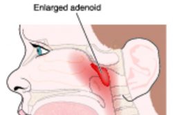 Аденоидит у детей: симптомы и лечение